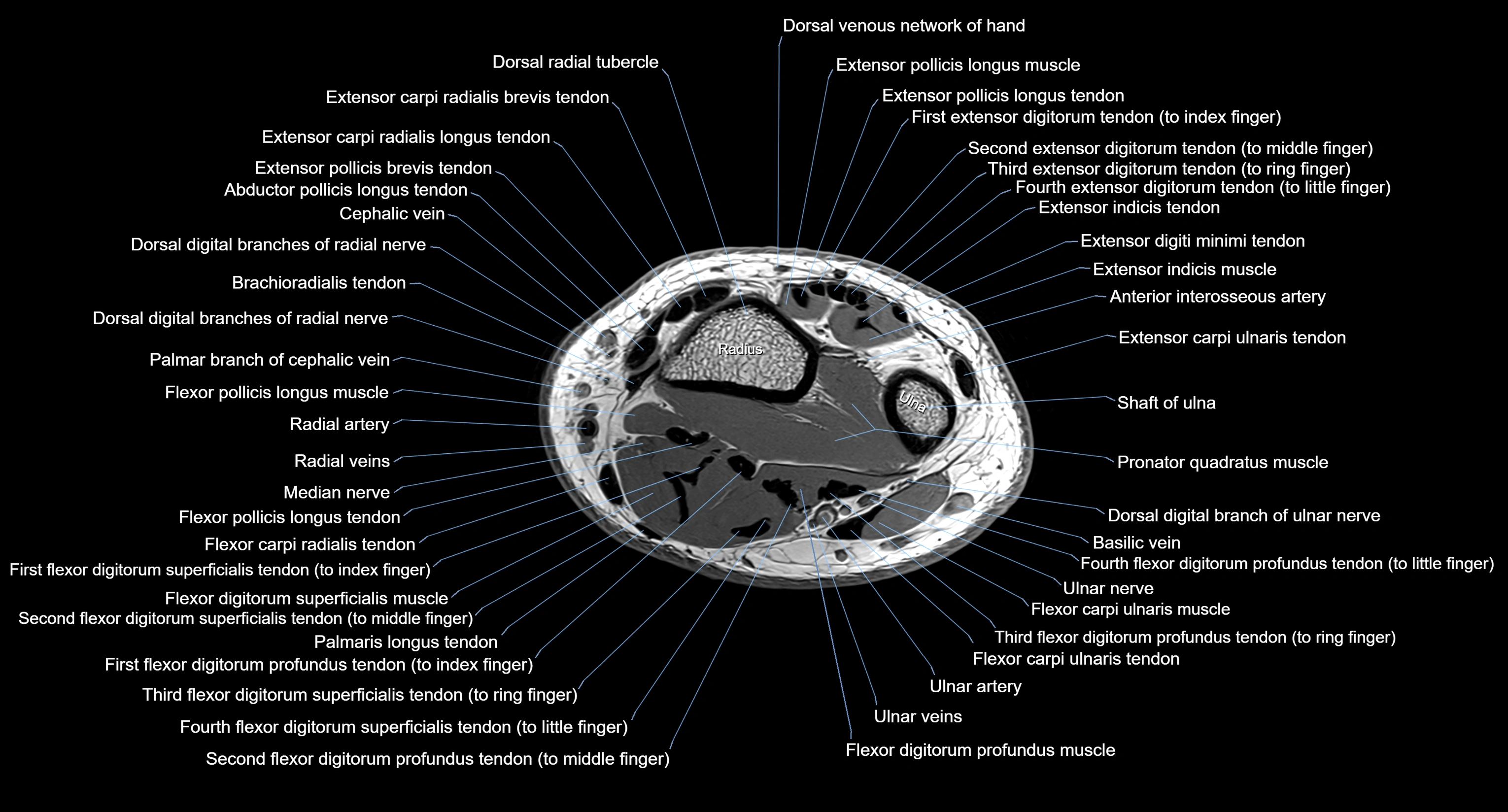 MRI wrist axial cross sectional anatomy 3T radiology  image-img-00001-00034.webp